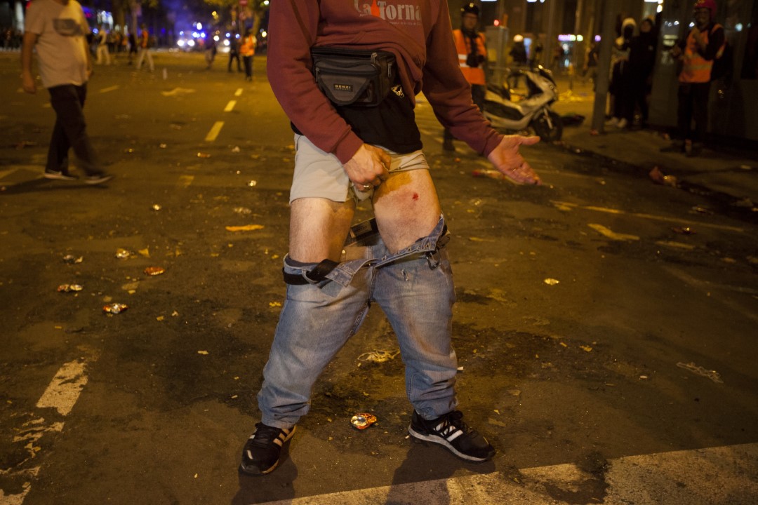 Un manifestant, mostra la ferida provocada per una bala de foam llençada per la policia. Sisena nit consecutiva d’avalots a Barcelona contra la sentència del judici del procés. 19 d’octubre de 2019.